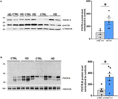 P2X7 Receptor Upregulation in Huntington’s Disease Brains